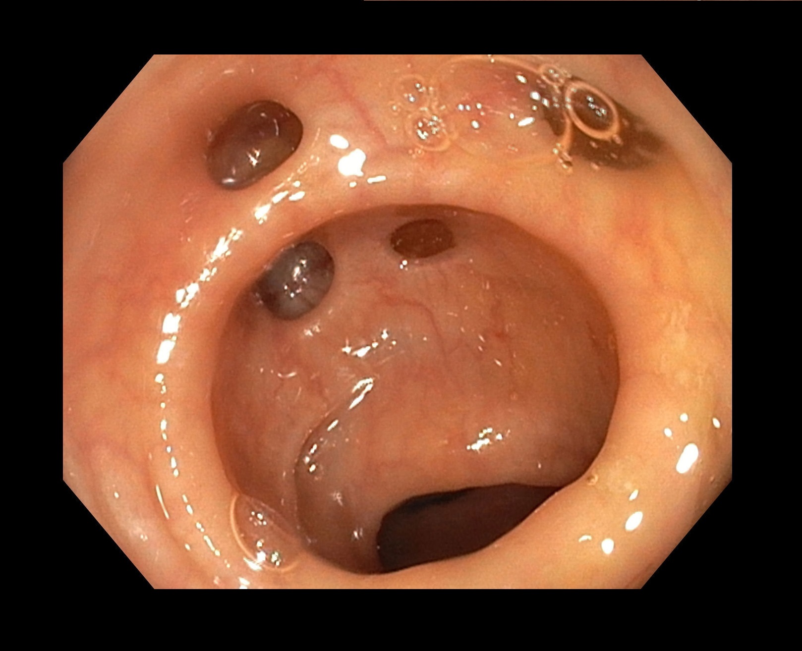 Diverticulose.jpg Diverticulose.jpg